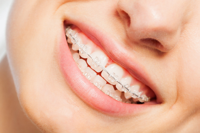 Keramikbrackets – KFO Schwarz, Tauberbischofsheim