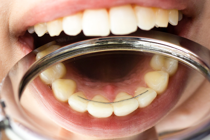 Retainer – KFO Schwarz, Tauberbischofsheim